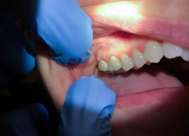 Best Dental Abscess Treatment in Dayton, OR
